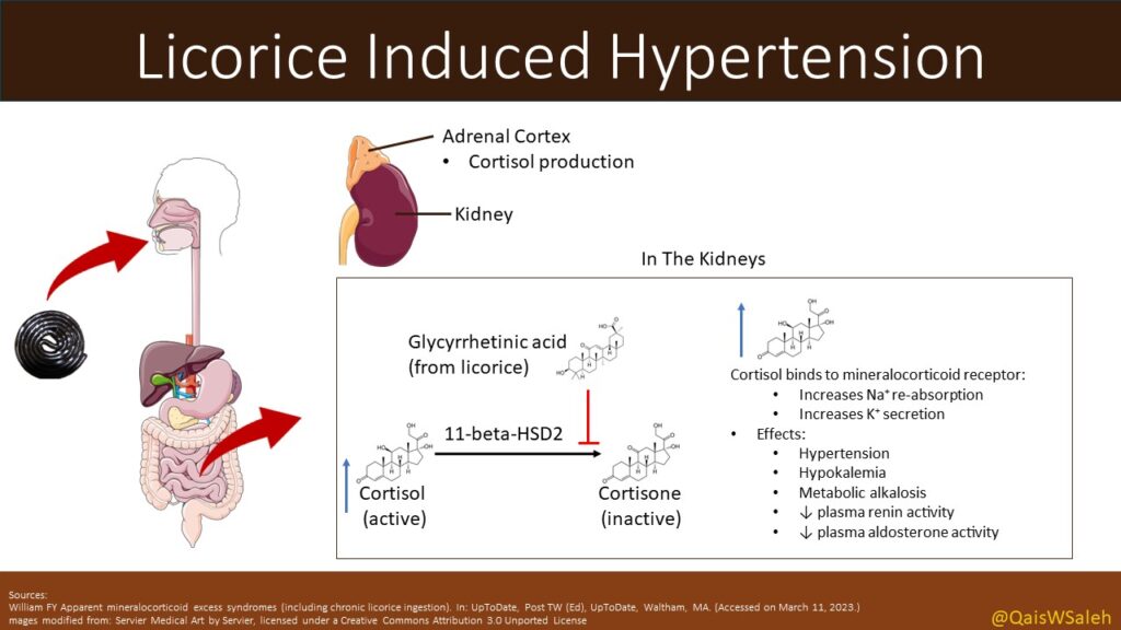 Licorice induced hypertension